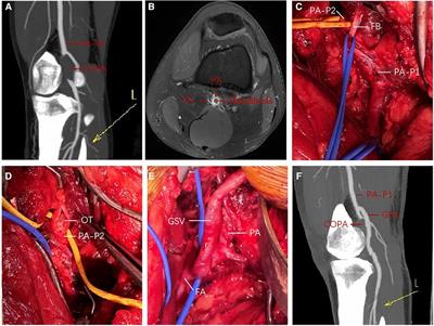 Case Report: COVID-19 exacerbates acute lower limb ischemia in patients with popliteal artery entrapment syndrome
